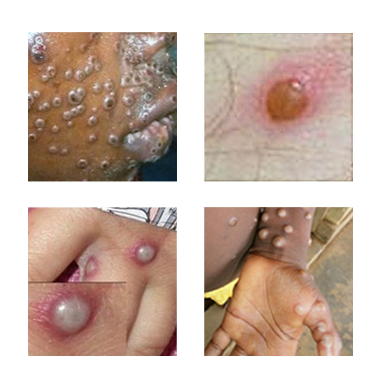 Key Characteristics of Monkeypox Rash – www.cdc.gov