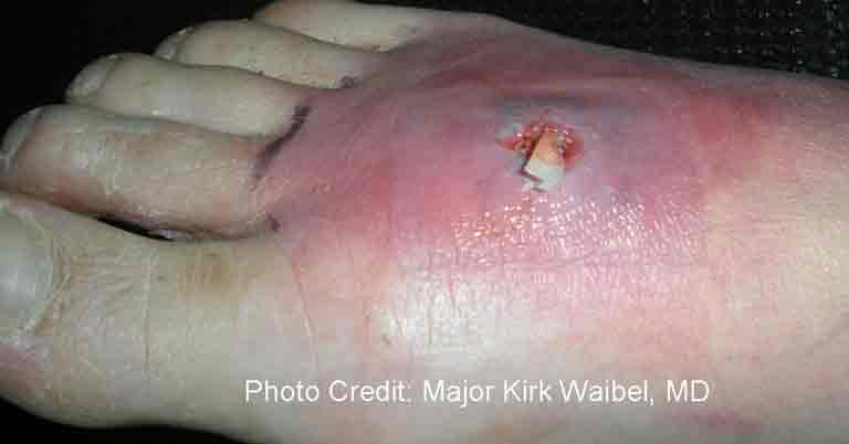 A foot with a large, swollen pink bump and pus from a MRSA infection
