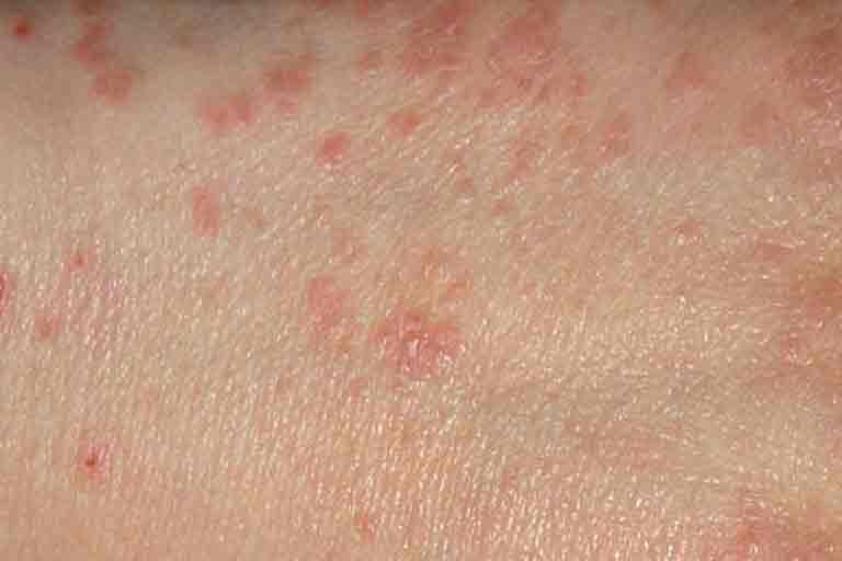 Close up view of red scabies bumps on skin
