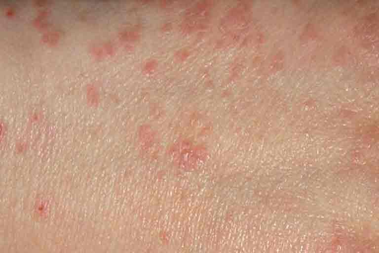 Scabies Communicable Diseases Public Environmental Health 